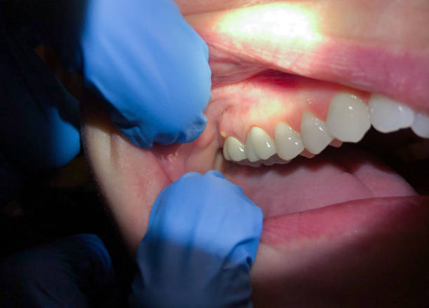 Best Emergency Gum Pain Relief  in Newburgh Heights, OH